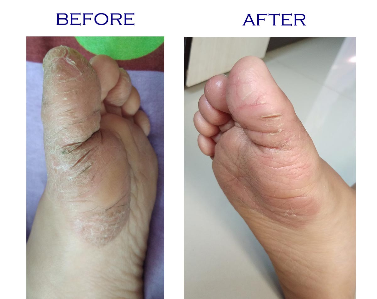 How to treat cracked or dry skin on toes due to dryness My Review Hall